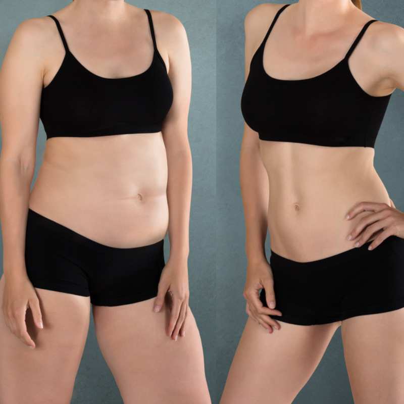 Does Fat Freezing at Home Work? DIY Devices vs Professional Cryolipolysis 2 before and after Cryolipolysis St George