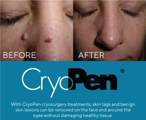 image of angiofibroma removal St George using Lipo Sculpt cryopen!